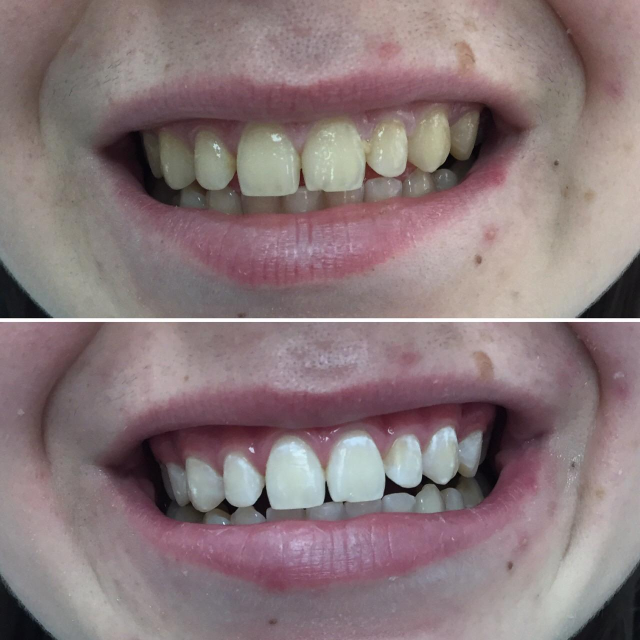 Зум 4 отбеливание зубов до и после
